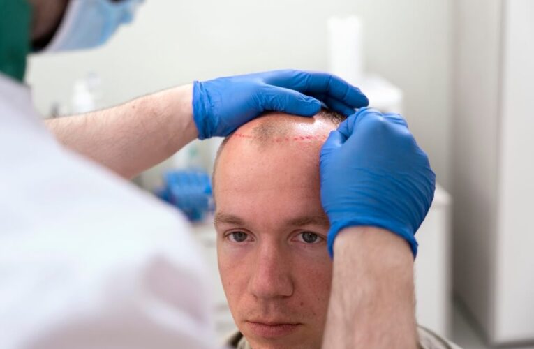PRP capilar: descubre los beneficios del tratamiento regenerativo para tu cabello